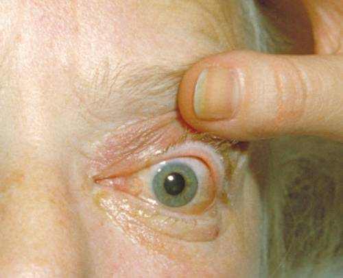 visual symptoms of eye tumor
