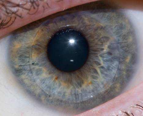 Is Astigmatism a Genetic Disorder?