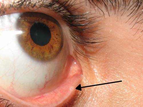 Infected Tear Duct