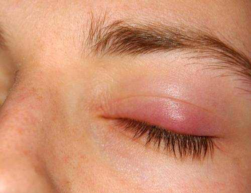 Swollen Upper Eyelid
