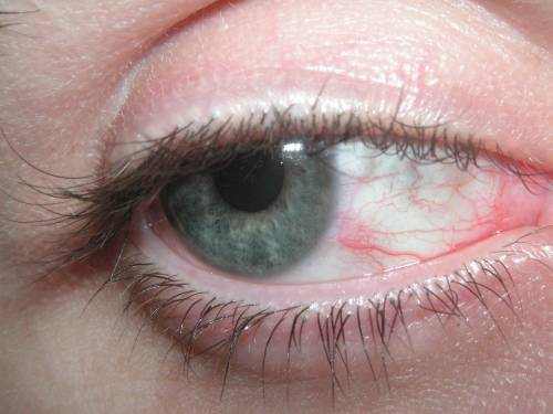 What Causes Red Veins In My Eyes