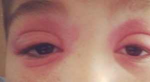 Poison Ivy in Eye and Eyelid: Causes and Remedies