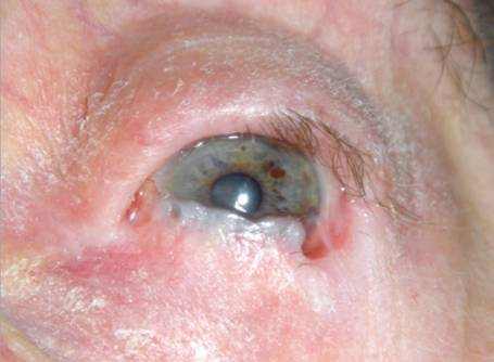 ocular cicatricial pemphigoid symptoms