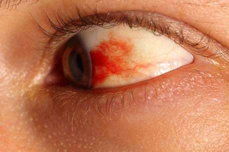 Broken Blood Vessel in Eye in the Morning