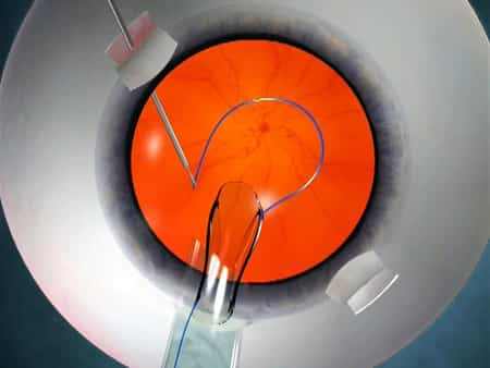 iol lenses cataract surgery