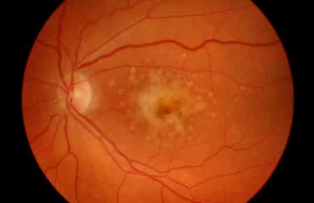 view of the retina