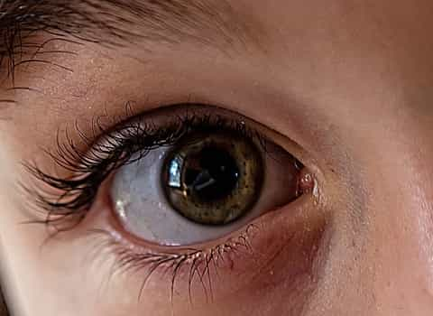 one pupil dilated more than other diuretic