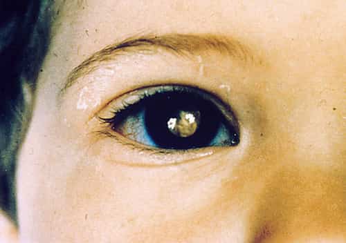 Retinoblastoma - eye cancer in child