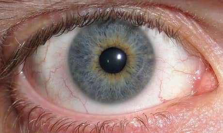 What Causes Yellow or Brown Rings Around Pupils?