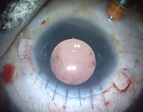 cataracts vs glaucoma