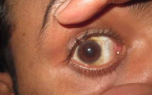 Flash burn in boy's eye