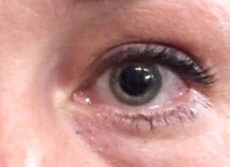 Woman with dilated left eye waits undilating