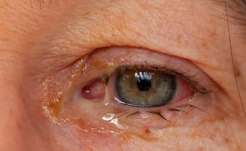 Excessive Eye Boogers: Causes, Types and Treatment – EYExan.com