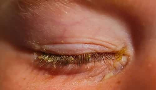 excessive-eye-boogers-causes-types-and-treatment-eyexan