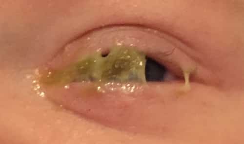 Image of excessive eye boogers in baby eye