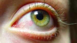 Squiggly Red Vein in Eye: Causes and Treatments – EYExan.com