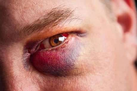 Black eye under lower eyelid