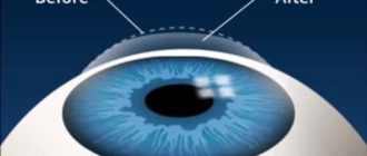 LASEK eye surgery: pricing and benefits