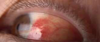 How Do You Get Rid of Red Itchy Eyes