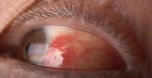 How Do You Get Rid of Red Itchy Eyes