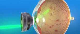Laser photocoagulation of the retina