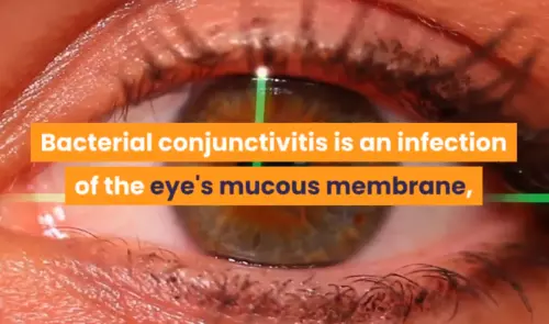 Watery eyes from staphylococcal conjunctivitis