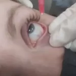 subconjunctival injection
