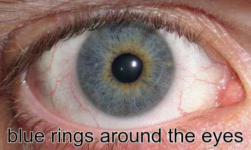 blue rings around the eyes