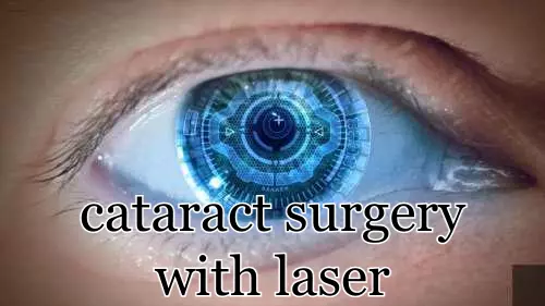 cataract surgery with laser
