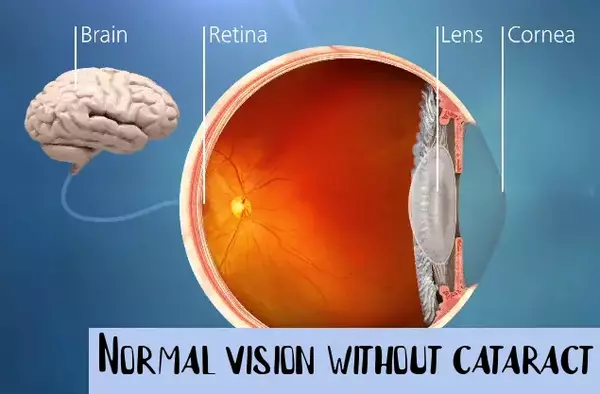 An eye before cataract