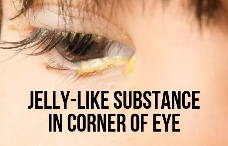 Jelly-Like Substance in Corner of Eye