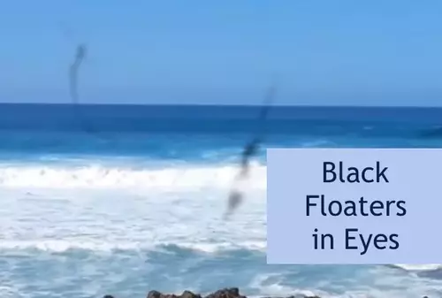 An example of what black floaters in the eyes look like