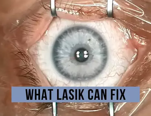 what lasik can fix