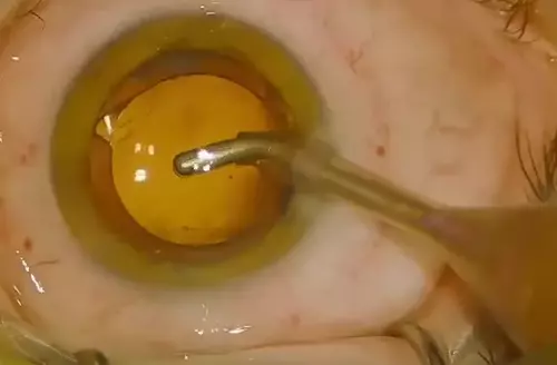 Cataract Surgery Lens installation