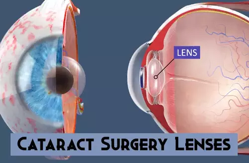 What lenses are used for cataract surgery?