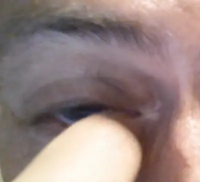 Man has eye discharge