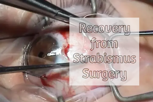 Recovery From Strabismus Surgery