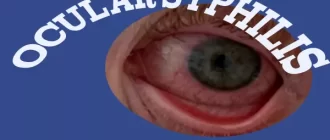 Ocular Syphilis