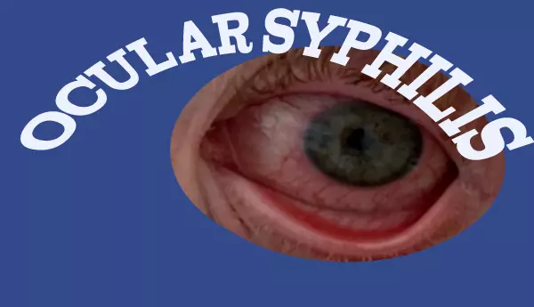 Ocular Syphilis