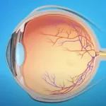 Retinal Detachment Repair