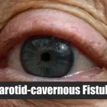 Carotid-cavernous Fistula