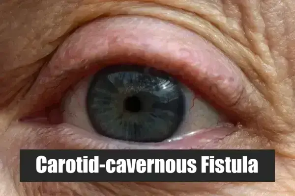 Carotid-cavernous Fistula