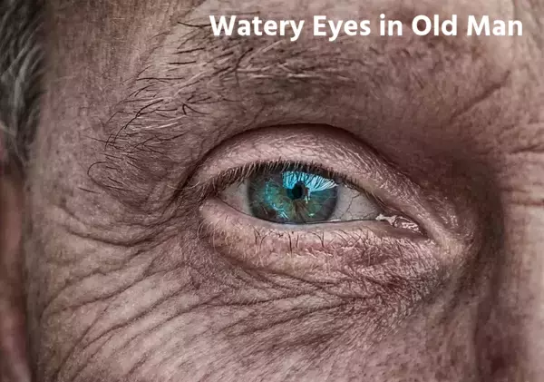 Watery Eyes