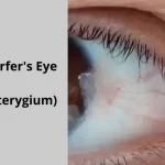 Pterygium, commonly known as Surfer's Eye