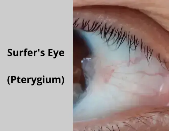 Pterygium, commonly known as Surfer's Eye