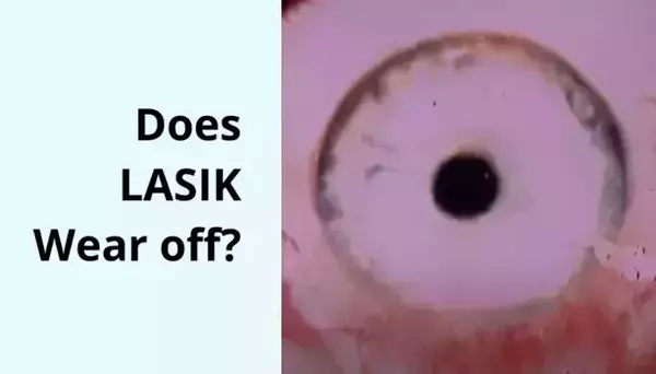 How Long Does LASIK Last?