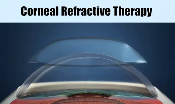 Corneal Refractive Therapy