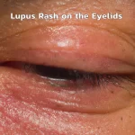 Lupus Rash on the Eyelids