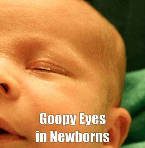 Goopy Eyes in Newborns