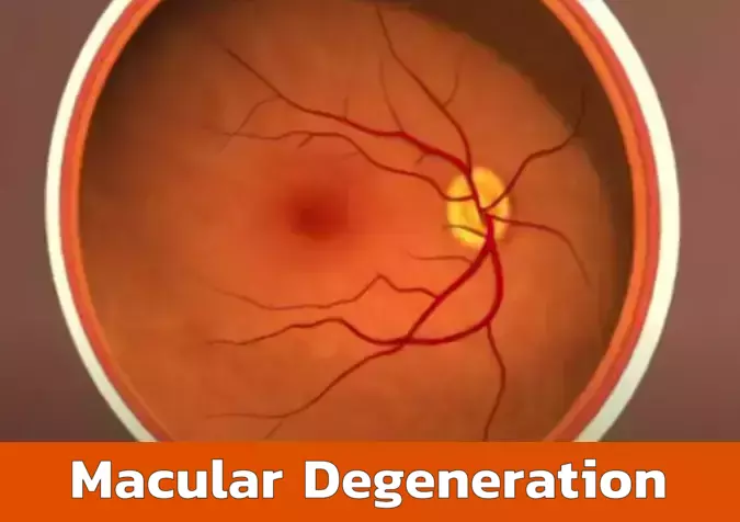 Macular Degeneration